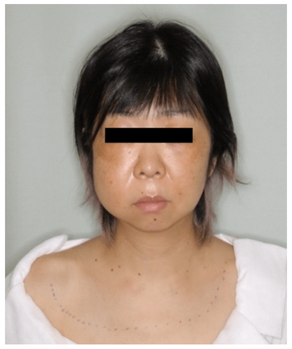 tràn khí dưới da sau nhổ răng